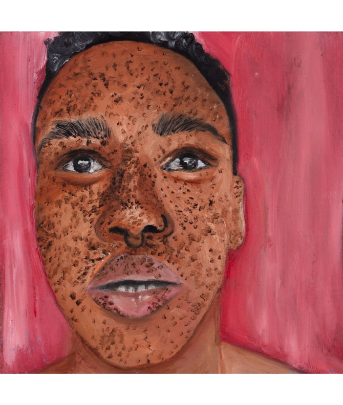 Freckled skin II